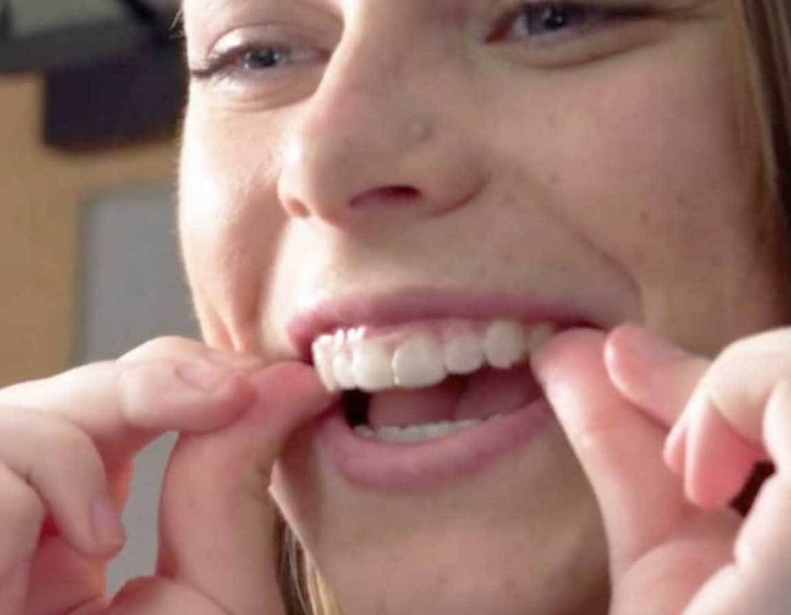 Whittier Palm Dental Fitting Dental Aligners 37787 Person fitting clear dental aligners at Whittier Palm Dental in Montebello, CA