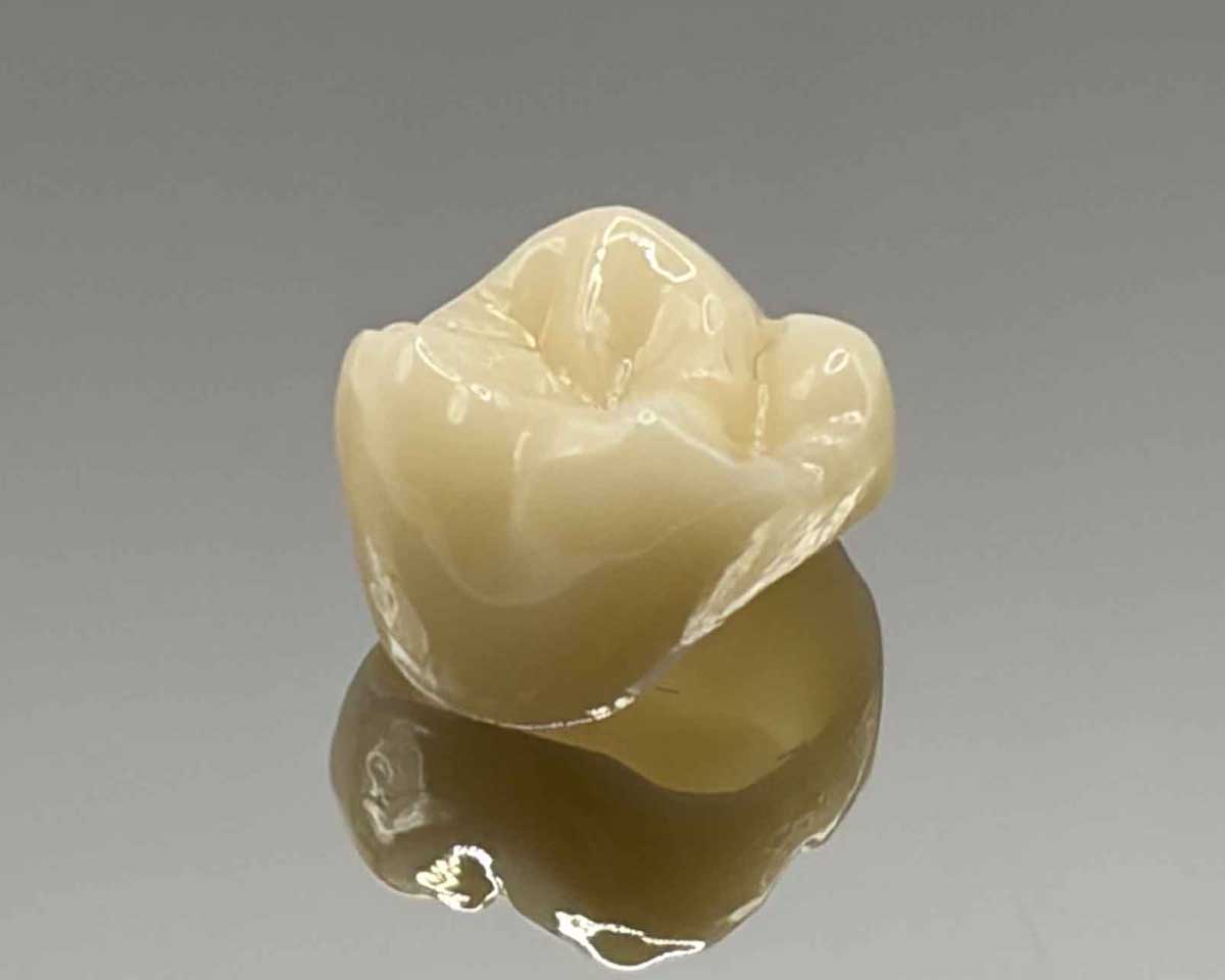 Whittier Palm Dental Dental Crown 31371 Close-up of dental crown reflecting on surface at Whittier Palm Dental in Montebello, CA