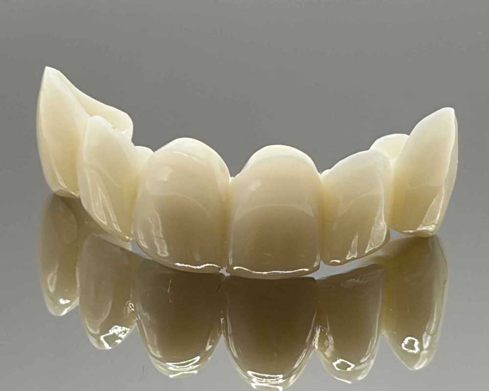 Whittier Palm Dental Dental Veneers 34699 Dental veneers displayed with reflection at Whittier Palm Dental in Montebello, CA