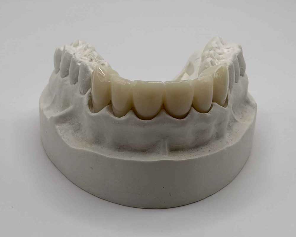 Whittier Palm Dental Dental Mold Model 48775 Whittier Palm Dental dental mold with artificial teeth model