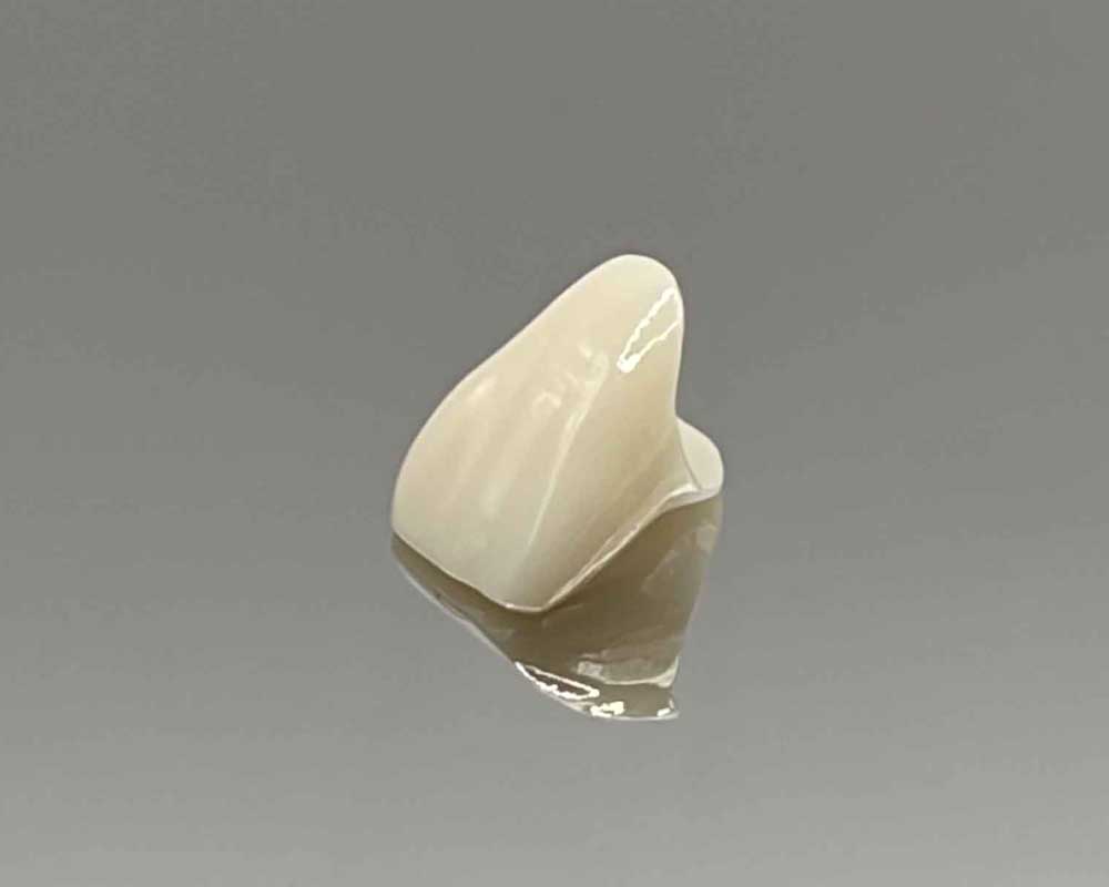 Whittier Palm Dental Dental Crown Restoration 90742 Close-up of dental crown restoration by Whittier Palm Dental in Montebello, CA