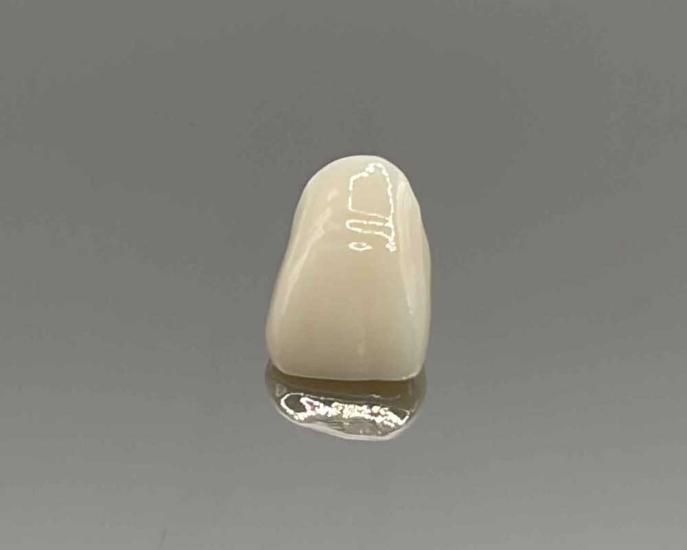 Whittier Palm Dental Single Dental Crown 56755 Dental crown restoration by Whittier Palm Dental in Montebello, CA on reflective surface